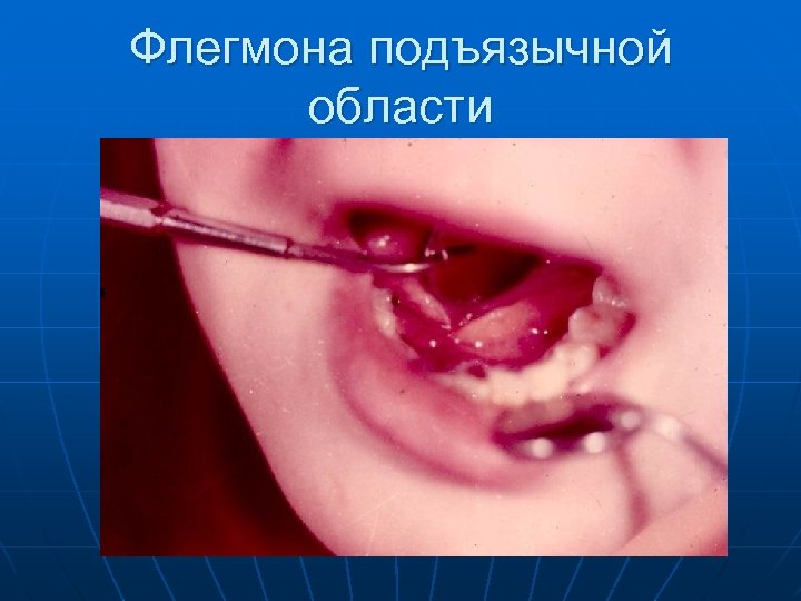 Флегмона подъязычной области 