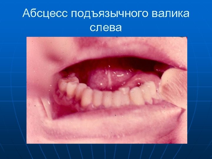Абсцесс подъязычного валика слева 