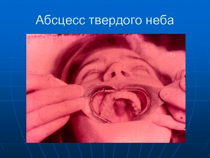 Абсцесс твердого неба 