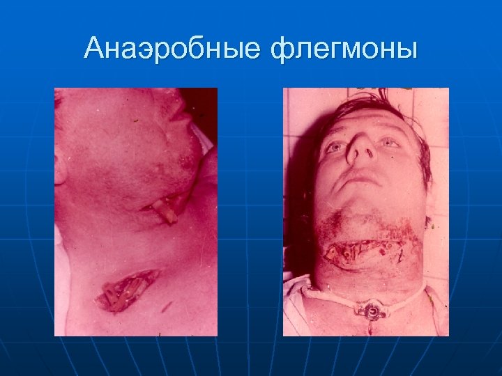 Анаэробные флегмоны 