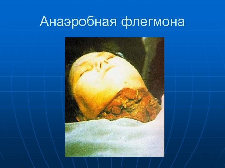 Анаэробная флегмона 