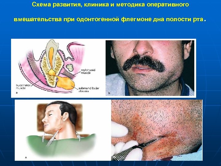Схема развития, клиника и методика оперативного . вмешательства при одонтогенной флегмоне дна полости рта