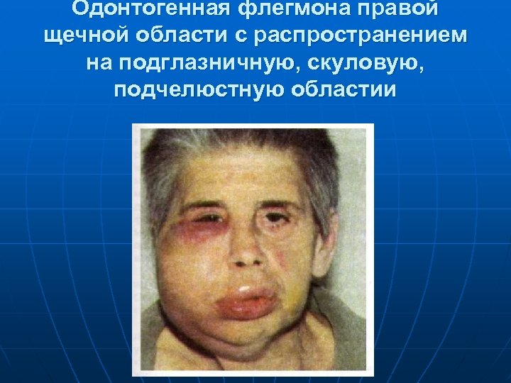 Одонтогенная флегмона правой щечной области с распространением на подглазничную, скуловую, подчелюстную областии 