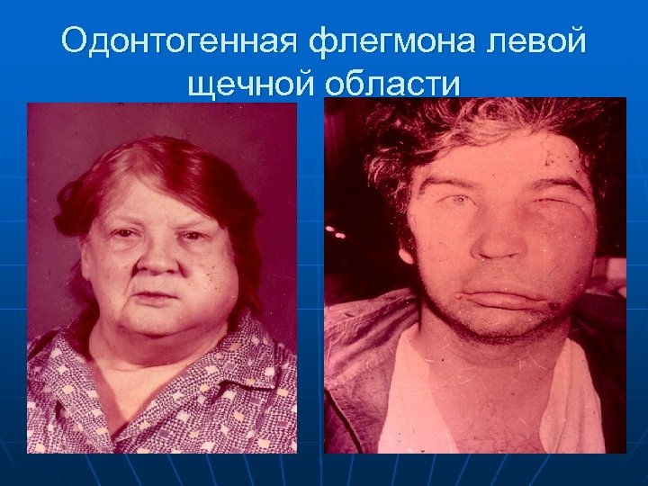 Одонтогенная флегмона левой щечной области 