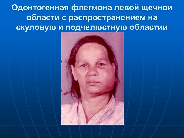 Одонтогенная флегмона левой щечной области с распространением на скуловую и подчелюстную областии 