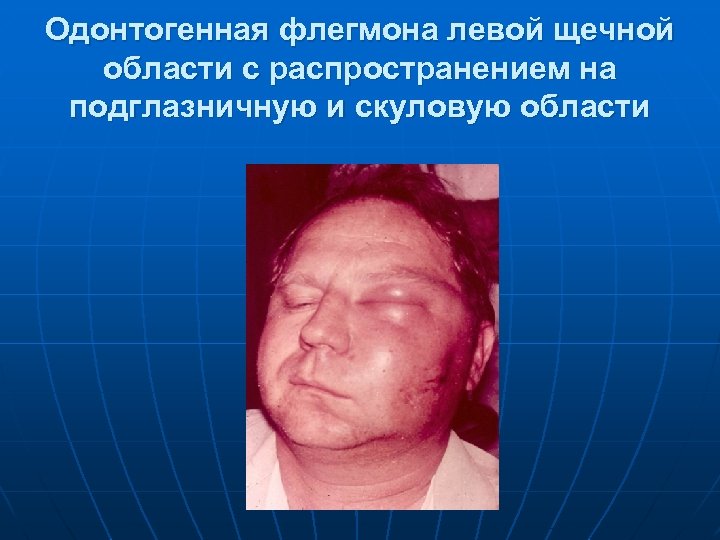 Одонтогенная флегмона левой щечной области с распространением на подглазничную и скуловую области 