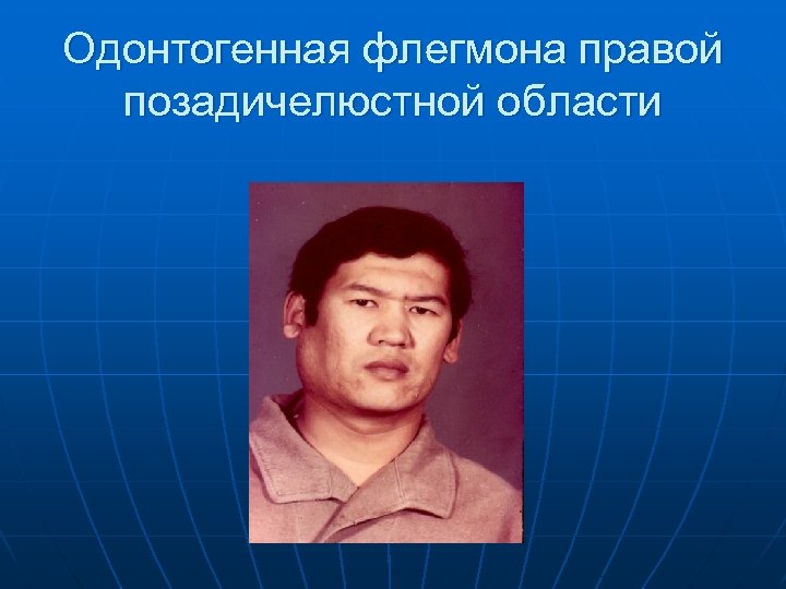 Одонтогенная флегмона правой позадичелюстной области 