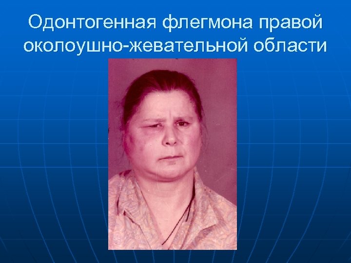 Одонтогенная флегмона правой околоушно-жевательной области 