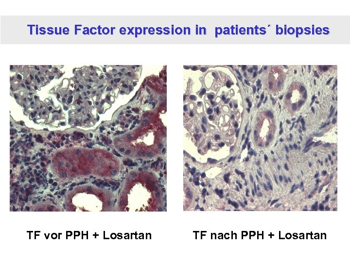 Tissue Factor expression in patients´ biopsies TF vor PPH + Losartan TF nach PPH