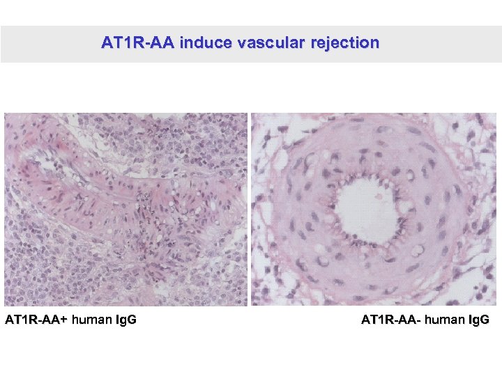 AT 1 R-AA induce vascular rejection AT 1 R-AA+ human Ig. G AT 1