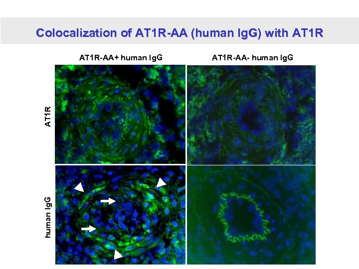 Colocalization of AT 1 R-AA (human Ig. G) with AT 1 R human Ig.