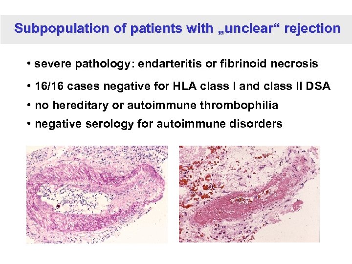 Subpopulation of patients with „unclear“ rejection • severe pathology: endarteritis or fibrinoid necrosis •