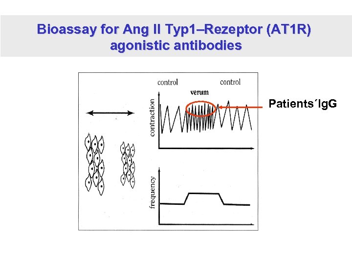 Bioassay for Ang II Typ 1–Rezeptor (AT 1 R) agonistic antibodies Patients´Ig. G 