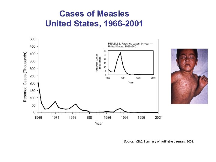 Cases of Measles United States, 1966 -2001 Source: CDC. Summary of notifiable diseases. 2001.