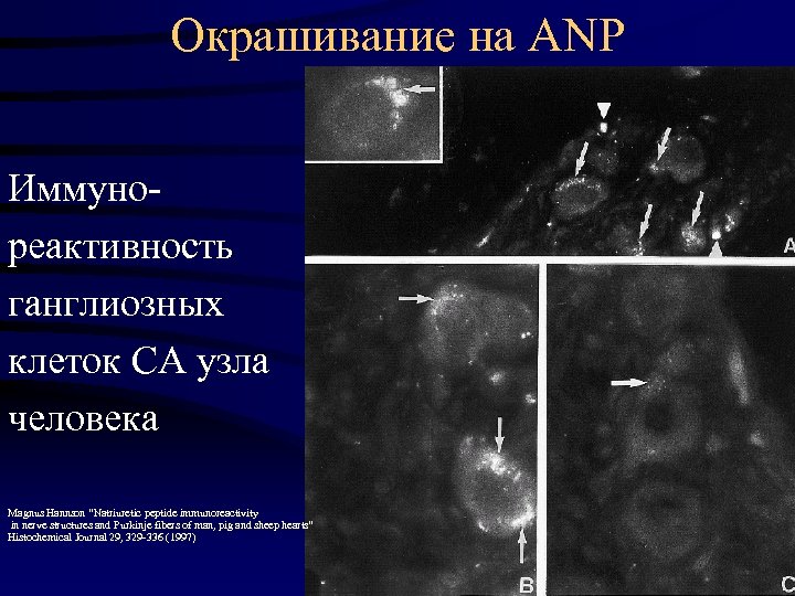 Окрашивание на ANP Иммунореактивность ганглиозных клеток СА узла человека Magnus Hannson “Natriuretic peptide immunoreactivity
