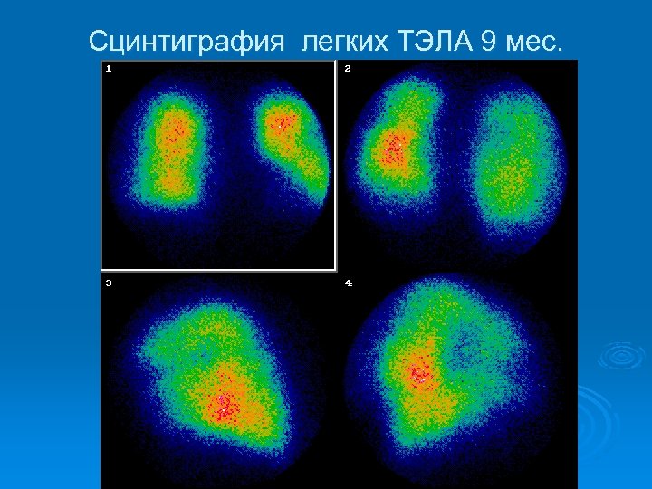 Сцинтиграмма является изображением