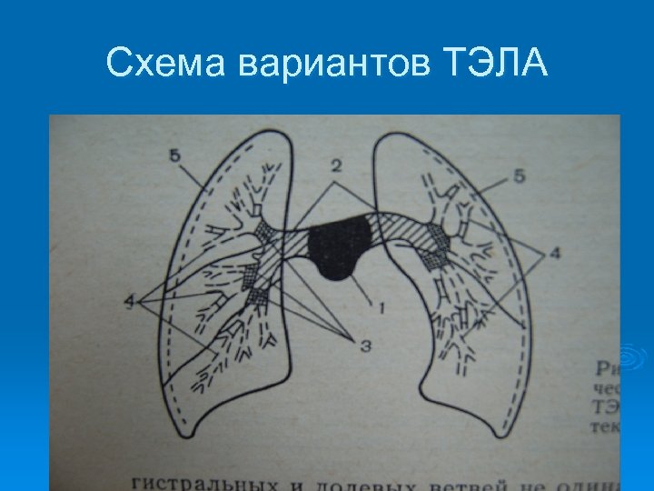 Схема вариантов ТЭЛА 