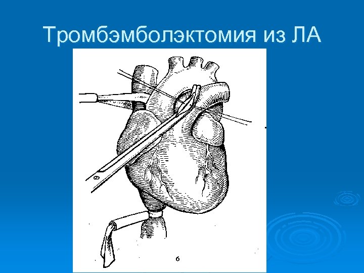 Тромбэмболэктомия из ЛА 