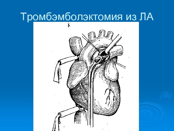 Тромбэмболэктомия из ЛА 