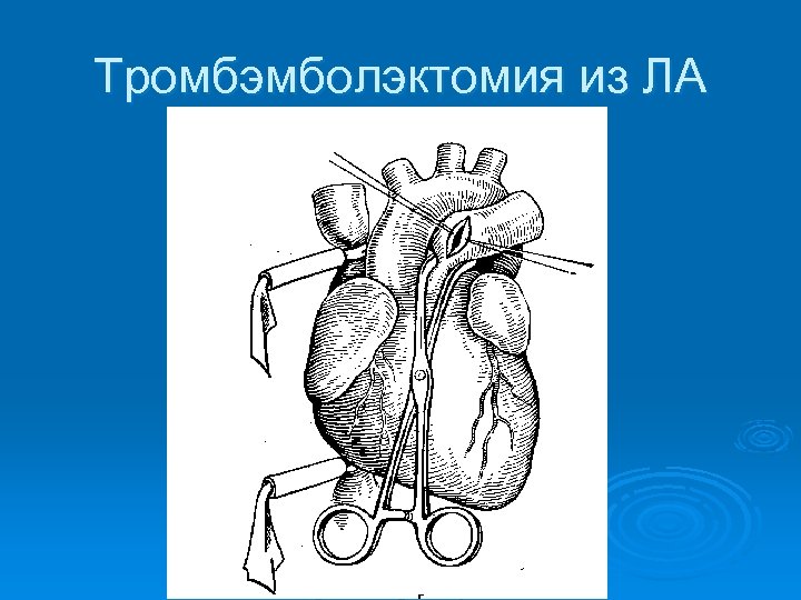 Тромбэмболэктомия из ЛА 