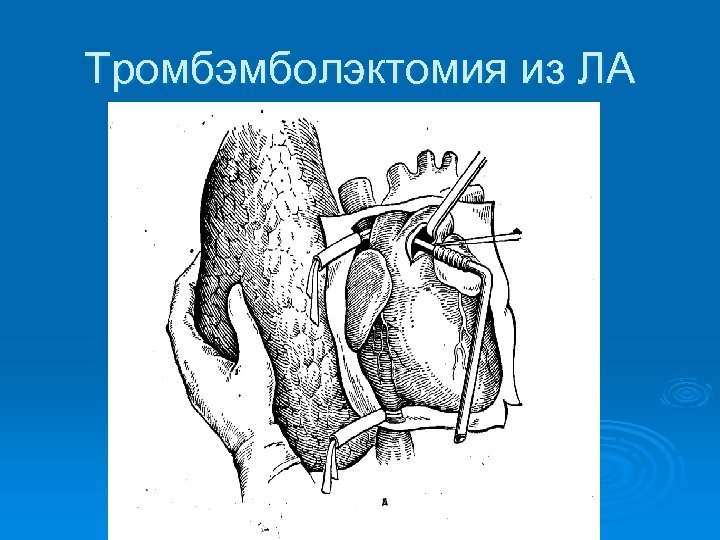 Тромбэмболэктомия из ЛА 