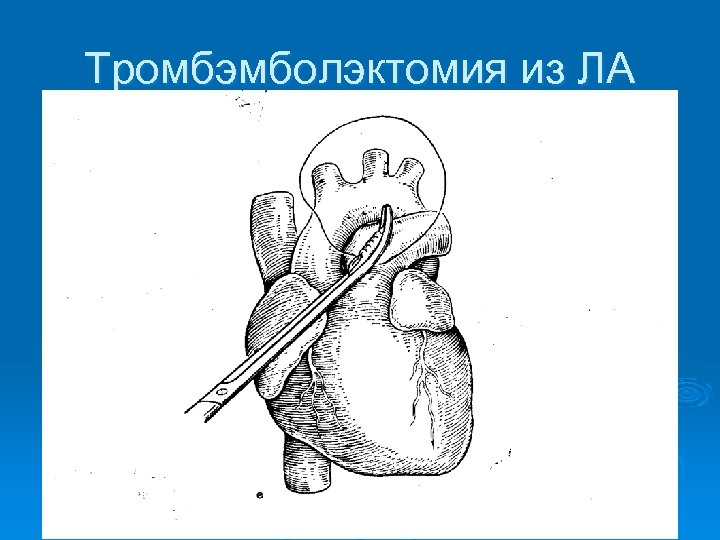 Тромбэмболэктомия из ЛА 