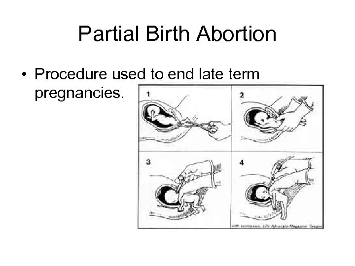 Partial Birth Abortion • Procedure used to end late term pregnancies. 