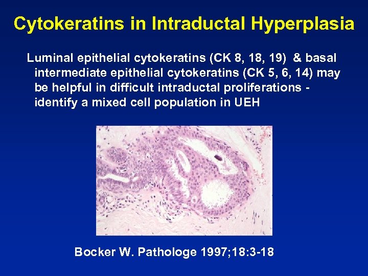 Cytokeratins in Intraductal Hyperplasia Luminal epithelial cytokeratins (CK 8, 19) & basal intermediate epithelial