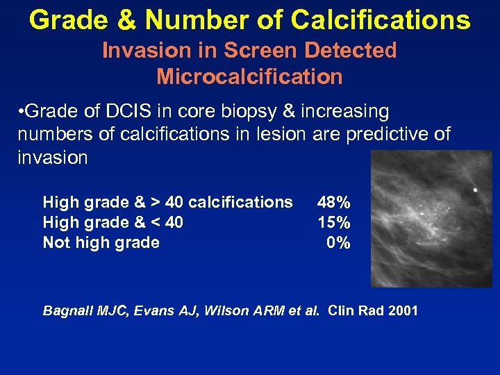 Grade & Number of Calcifications Invasion in Screen Detected Microcalcification • Grade of DCIS