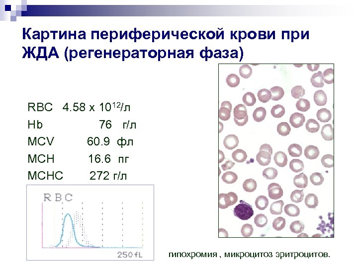 Для железодефицитной анемии характерна такая картина периферической крови