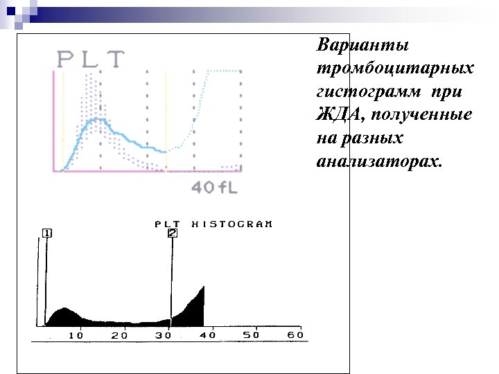 Варианты тромбоцитарных гистограмм при ЖДА, полученные на разных анализаторах. 