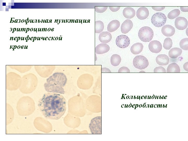 Базофильная пунктация эритроцитов периферической крови Кольцевидные сидеробласты 