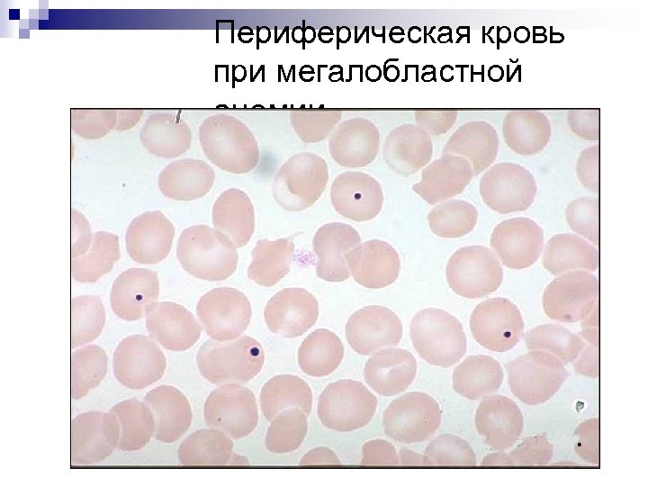 Картина крови при мегалобластной анемии