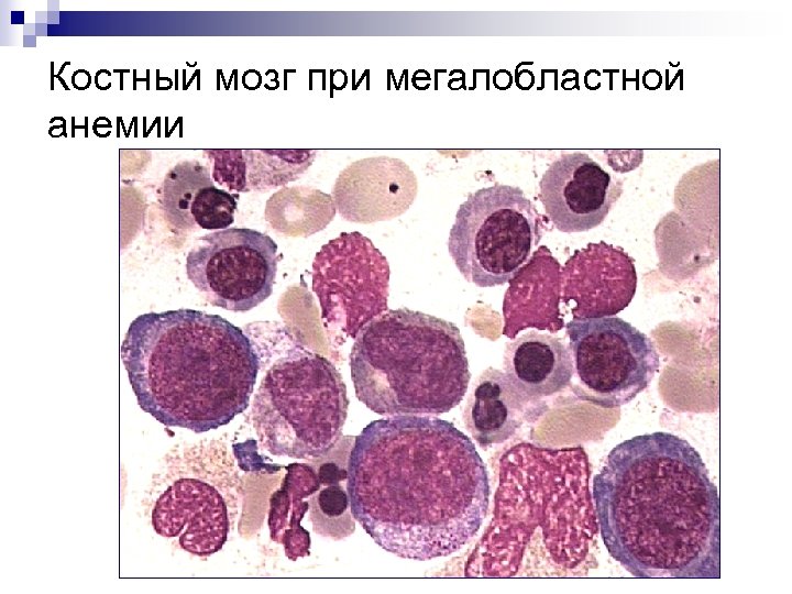 Костный мозг при мегалобластной анемии 