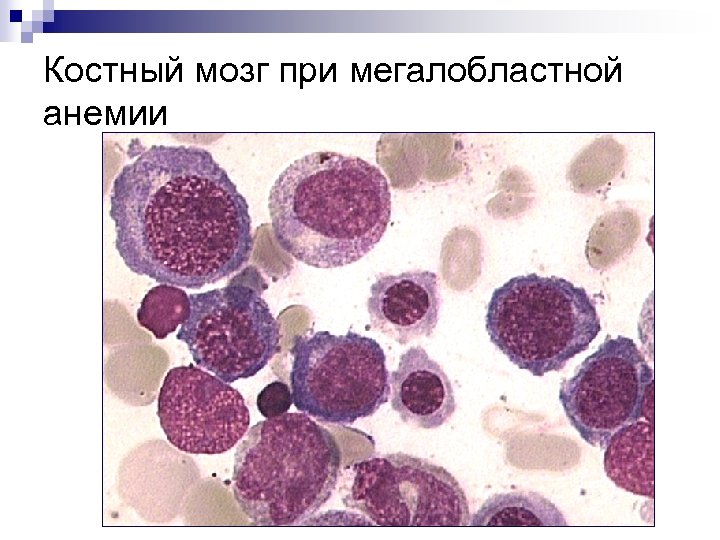 Морфологическая картина гипоплазии костного мозга