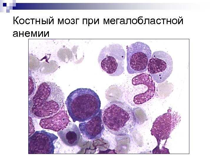 Мегалобластная анемия клиническая картина