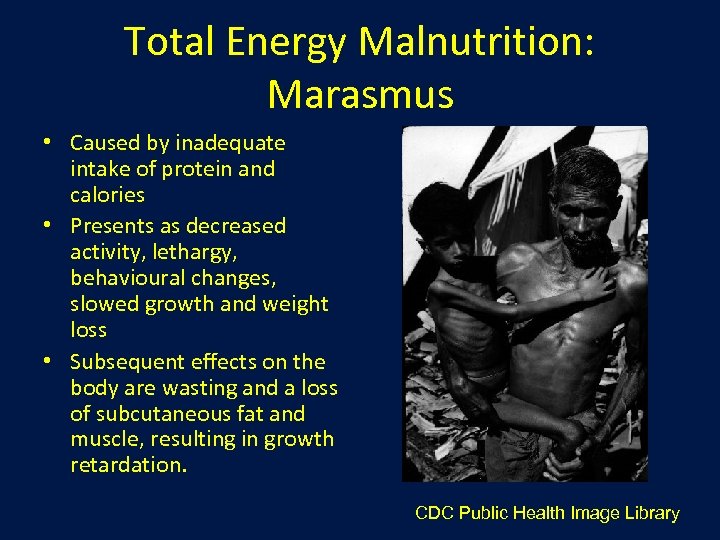Total Energy Malnutrition: Marasmus • Caused by inadequate intake of protein and calories •