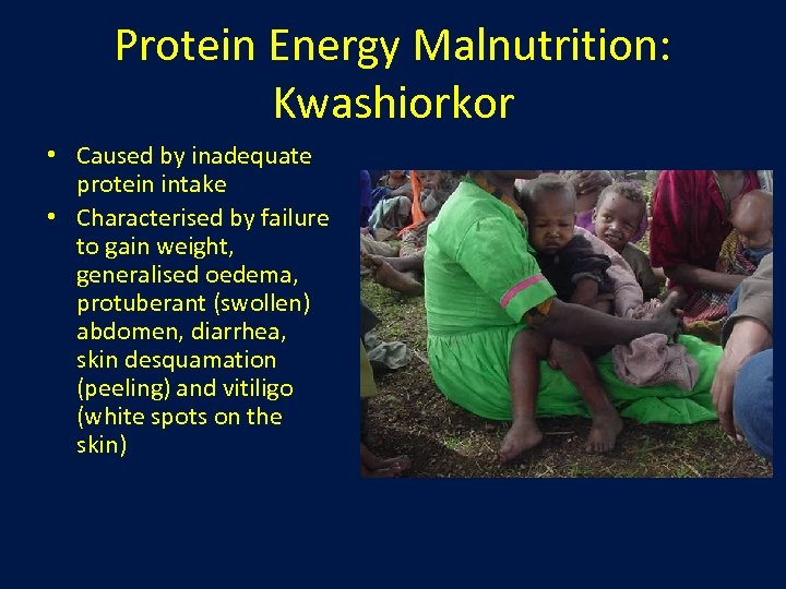 Protein Energy Malnutrition: Kwashiorkor • Caused by inadequate protein intake • Characterised by failure