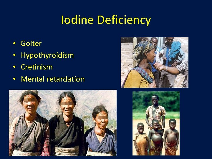 Iodine Deficiency • • Goiter Hypothyroidism Cretinism Mental retardation 