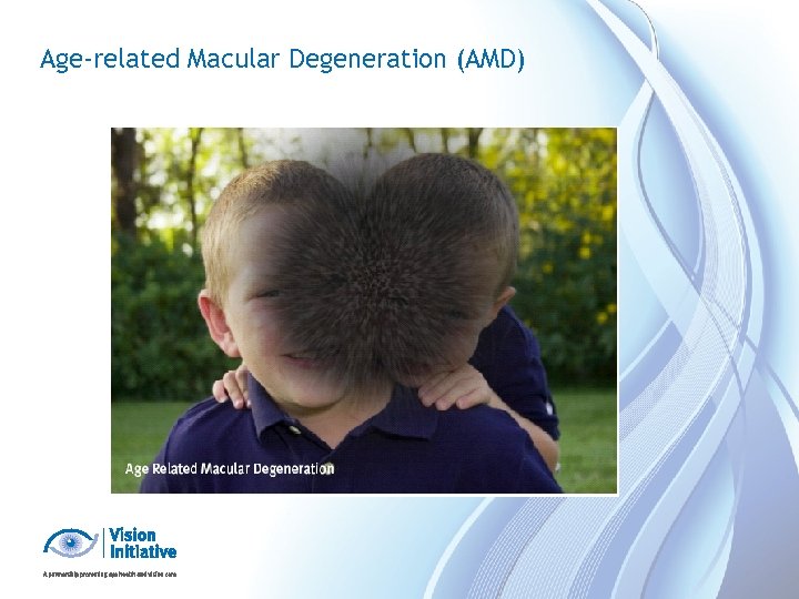 Age-related Macular Degeneration (AMD) 