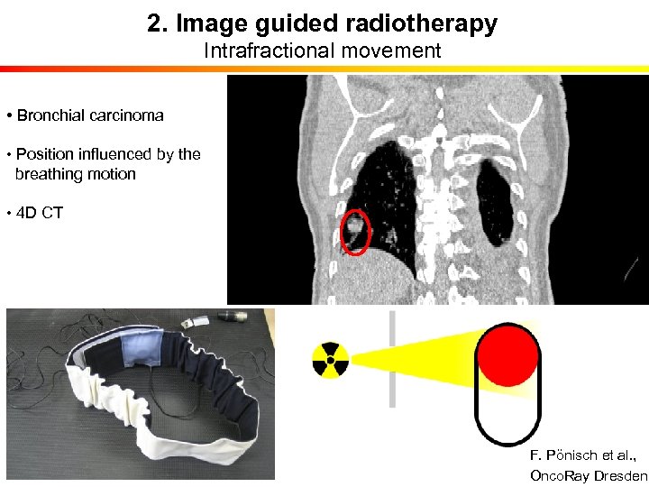 2. Image guided radiotherapy Intrafractional movement • Bronchial carcinoma • Position influenced by the