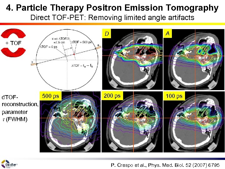 4. Particle Therapy Positron Emission Tomography Direct TOF-PET: Removing limited angle artifacts D A