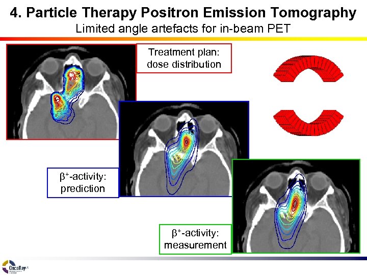 4. Particle Therapy Positron Emission Tomography Limited angle artefacts for in-beam PET Treatment plan: