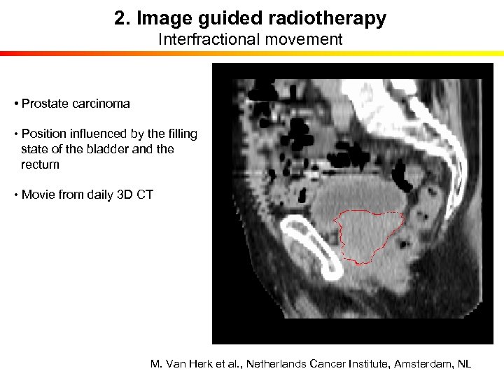 2. Image guided radiotherapy Interfractional movement • Prostate carcinoma • Position influenced by the