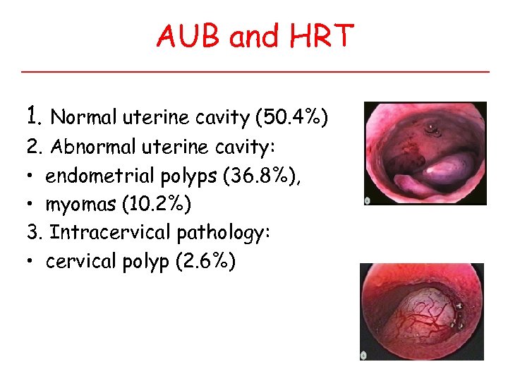 AUB and HRT 1. Normal uterine cavity (50. 4%) 2. Abnormal uterine cavity: •