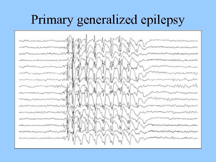 Primary generalized epilepsy 