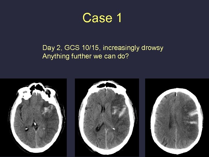 Case 1 Day 2, GCS 10/15, increasingly drowsy Anything further we can do? 