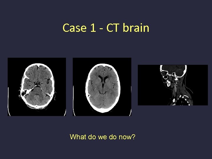Case 1 - CT brain What do we do now? 