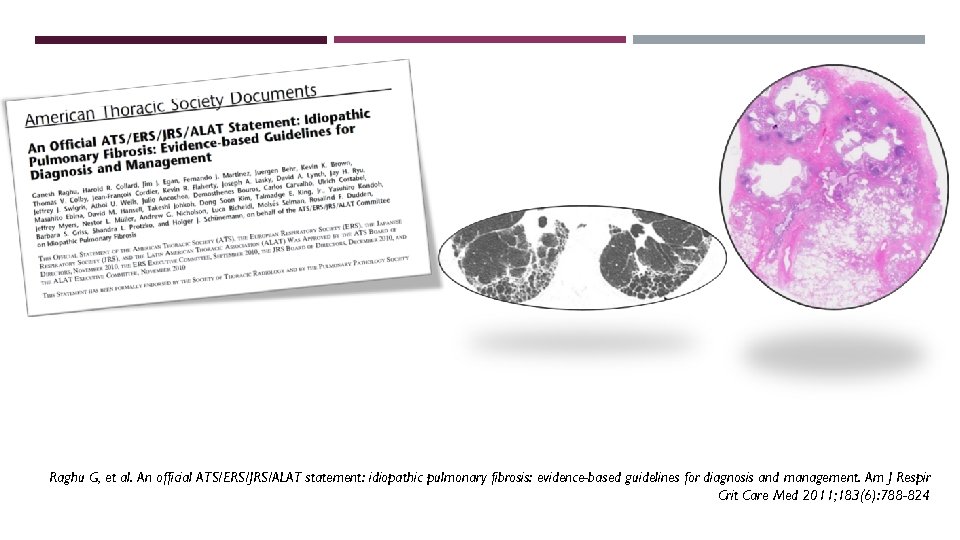 Raghu G, et al. An official ATS/ERS/JRS/ALAT statement: idiopathic pulmonary fibrosis: evidence-based guidelines for