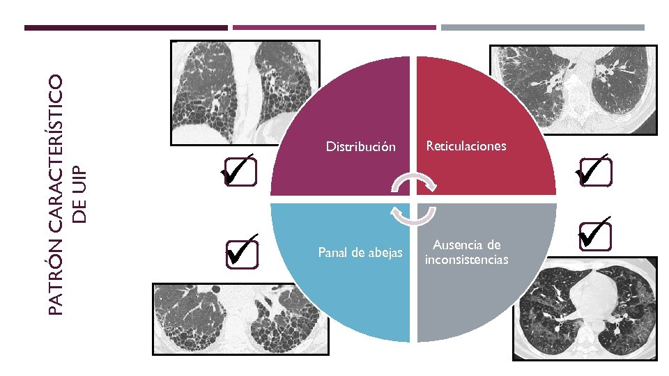 PATRÓN CARACTERÍSTICO DE UIP ü ü Distribución Reticulaciones Panal de abejas Ausencia de inconsistencias